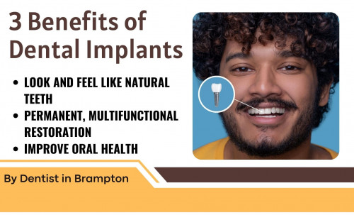 3-Benefits-of-Dental-Implants-By-Dentist-in-Brampton.jpg