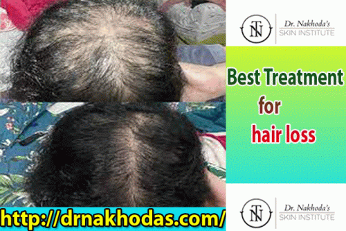 Best Treatment for hair loss