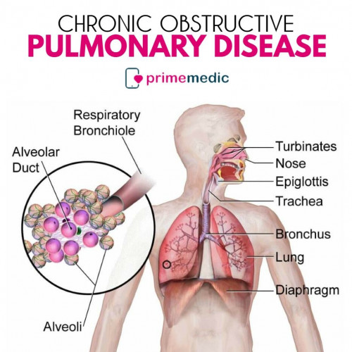 Chronic-Obstructive-Pulmonary-Disease.jpg