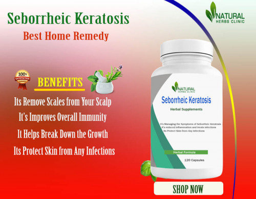 Natural Remedies for Seborrheic Keratosis include apple cider vinegar and tea tree oil have been shown to help with the pain. https://www.dubaient.com/natural-remedies-for-seborrheic-keratosis-suitable-treatment-technique
