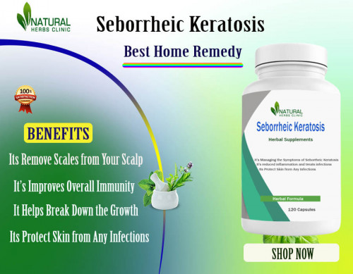 It has been proven that Home Remedies for Seborrheic Keratosis like apple cider vinegar and tea tree oil will assist with the discomfort. https://www.natural-health-news.com/seborrheic-keratosis-gain-natural-cure-with-home-remedies/