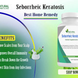 Seborrheic-Keratosis-Gain-Natural-Cure-with-Home-Remedies