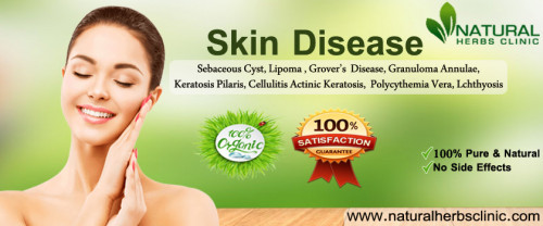 Patients with any skin issues or any other health disease can easily find herbal products and remedies at Natural Herbs Clinic for their condition treatment. some of them we going to describe here... https://natural-herbs-clinic.my-free.website/