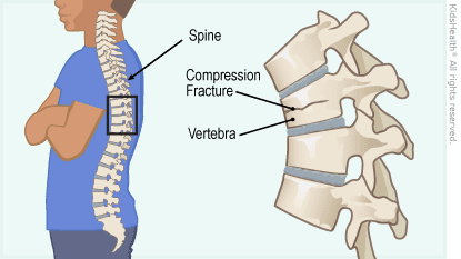 Spine-Fracture.png