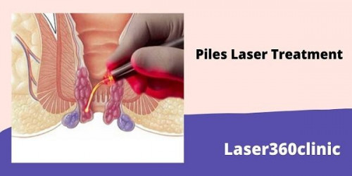 piles-laser-treatment-cost.jpg