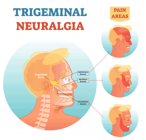 trigeminal-neuralgia.png